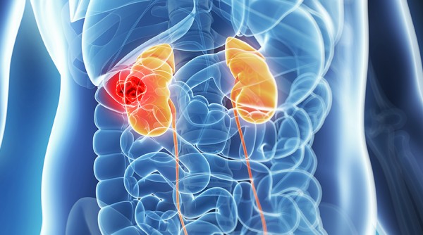 Kidney Cancer